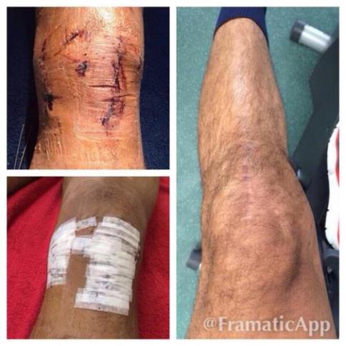 Theo Walcott Knee